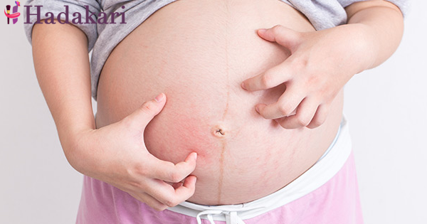අම්මා කෙනෙක්ට ගර්භණී සමයේදී සිරුර මත ඇති වෙන කැසීම් සඳහා පිළියම් | Remedies for skin itchiness in pregnancy