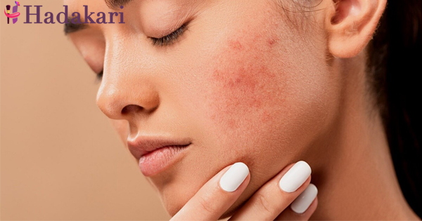 මානසික ආතතිය නිසා ඇතිවන කුරුලෑ සහ ඒවා පාලනය කර ගන්නා ආකාරය | stress acne and how to deal with it