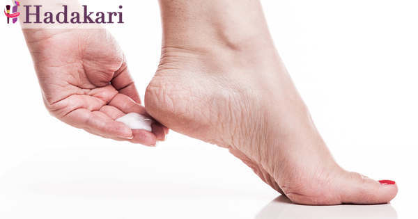 යටි පතුල් පැලීම ඔයාටත් හිසරදයක් වෙලාද? | Have foot cracks become a headache for you? 