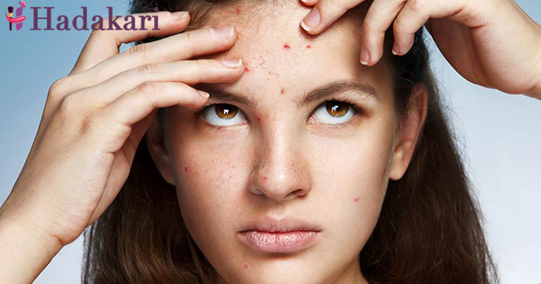 කුරුලෑ ඇති වෙන්න පෙර වළක්වා ගන්න | Precautions to prevent acne or pimple