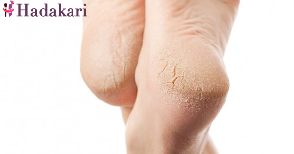 Are you aware of dry cracked feet?