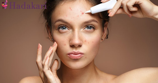 ගෑනු ළමයින්ගෙ ලොකුම ප්‍රශ්නයක් වුනු මූණෙ පිම්පල් මකන සාස්තරේ | How to get rid of Acne