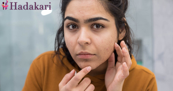 කුරුලෑ වලට බෙහෙත් ගන්න කලින් මේ දේවල් කලාද? දැන්වත් මේ දේවල් කරලා බලන්න | Didn’t you try these treatments for pimples
